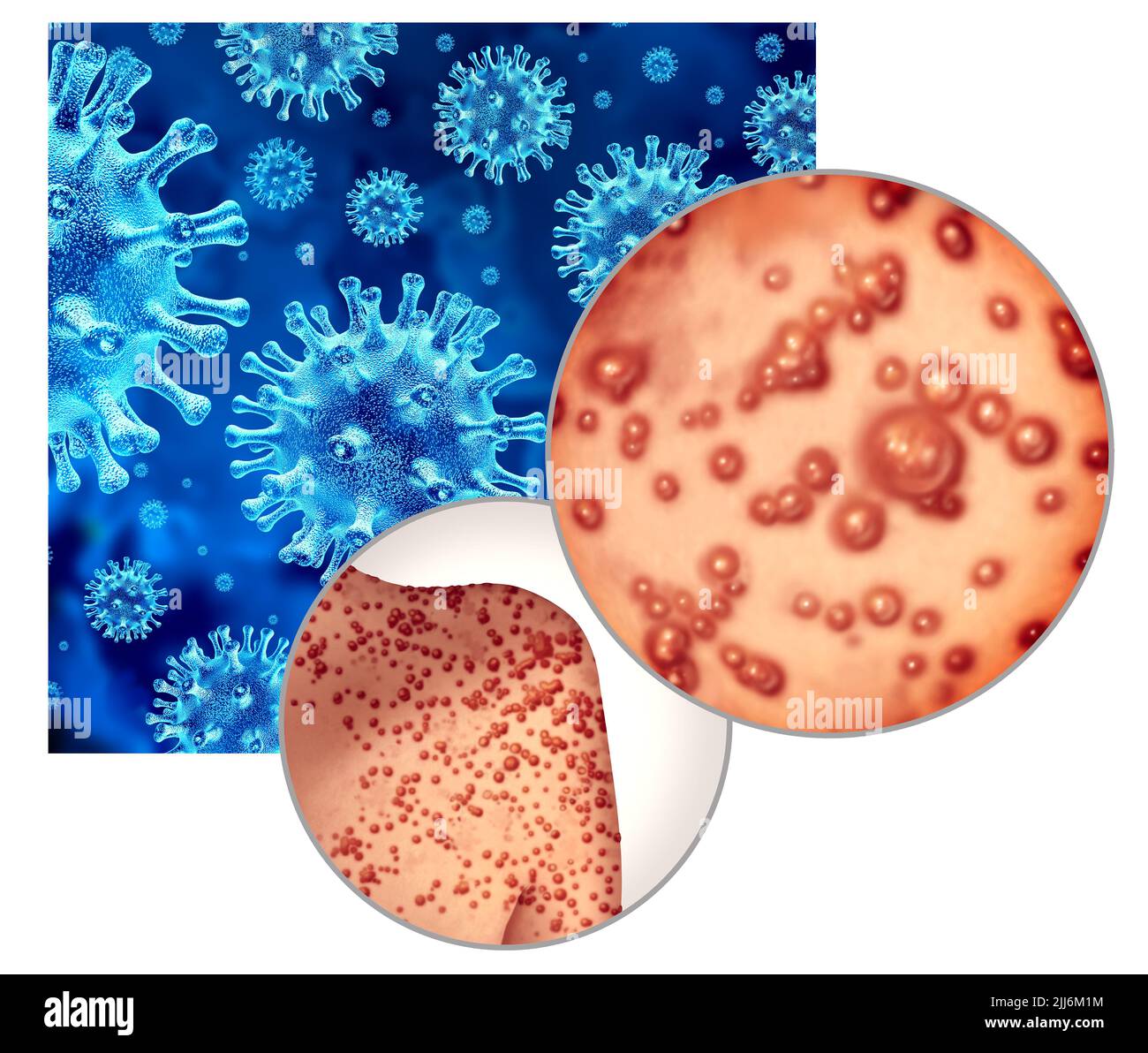 Der Ausbruch des Monkeypox-Virus als ansteckende Infektion durch Blasen und Gifte auf der Haut, die die Übertragung einer infizierten Person darstellen. Stockfoto