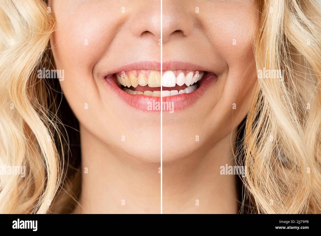 Lächelnde Frau vor und nach dem Zahnaufhellungsverfahren, Nahaufnahme. Stockfoto