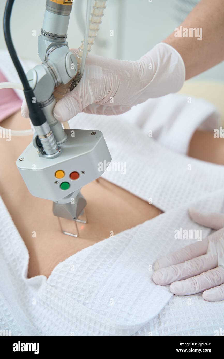 Verfahren zur Laserentfernung von Neoplasmen am Bauch in einer Kosmetologie-Klinik Stockfoto