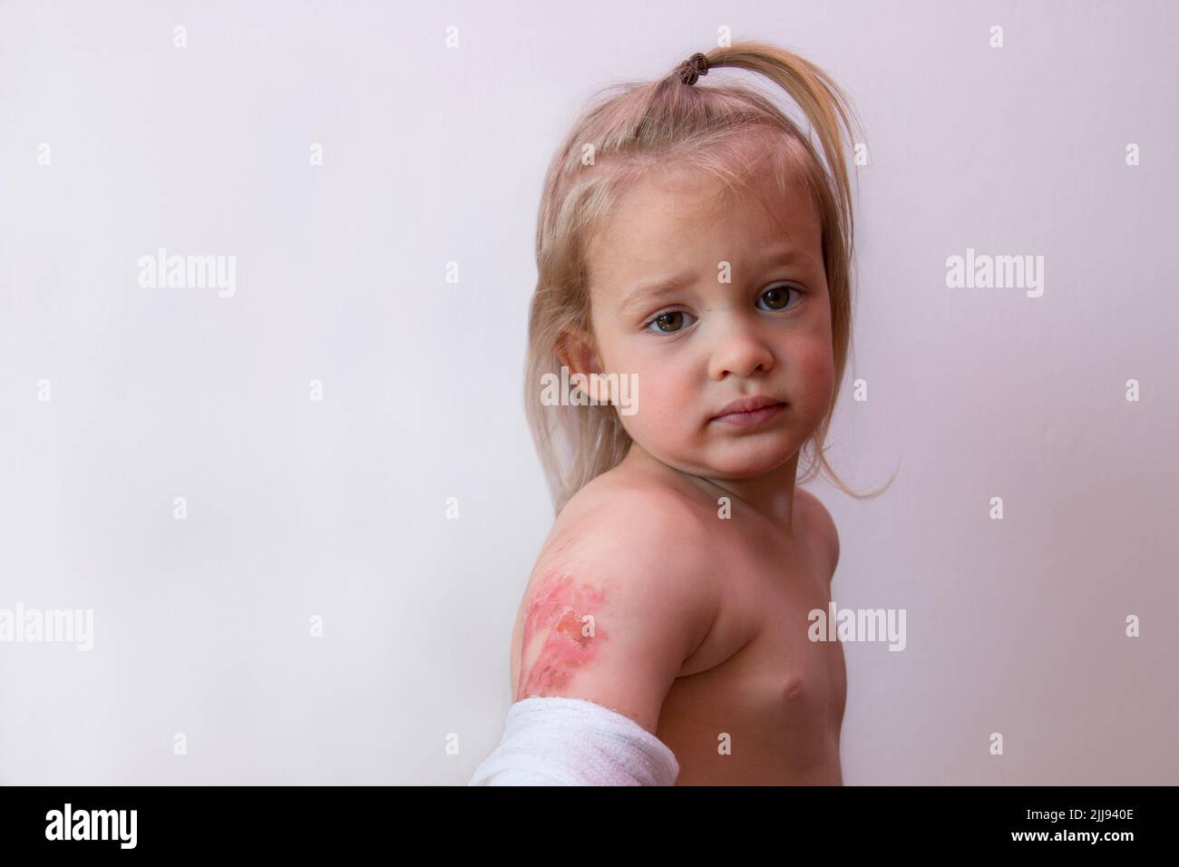 Verbrannter Arm eines kleinen Kindes, Kinder verbrennt Verletzungen, nette Trouble-Junge Kleinkind mit zweiten Grad Verbrühung, kopieren Raum Hintergrund Stockfoto