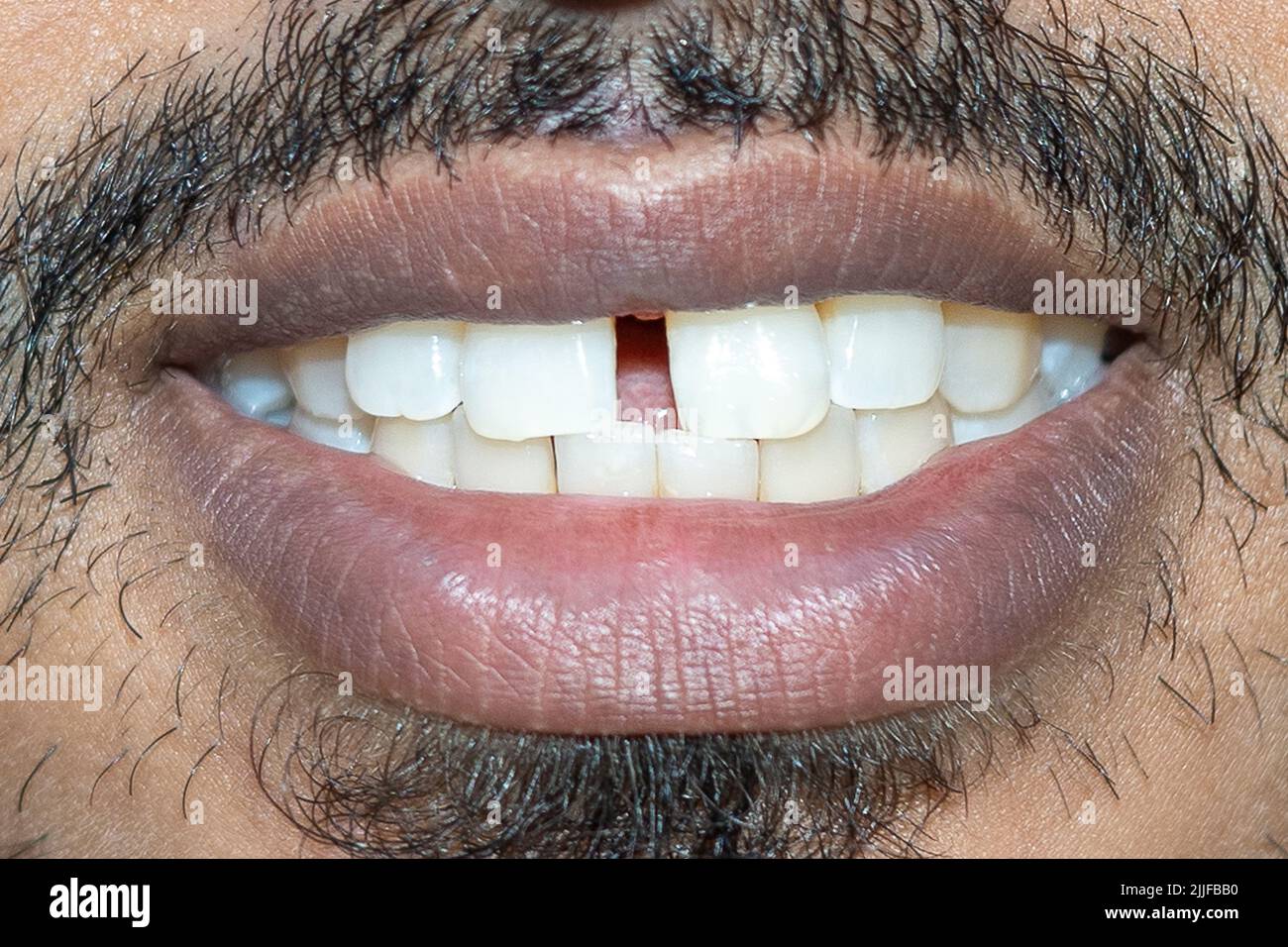 Alte Füllungen an den Zähnen. 24-07-2022 Stockfoto