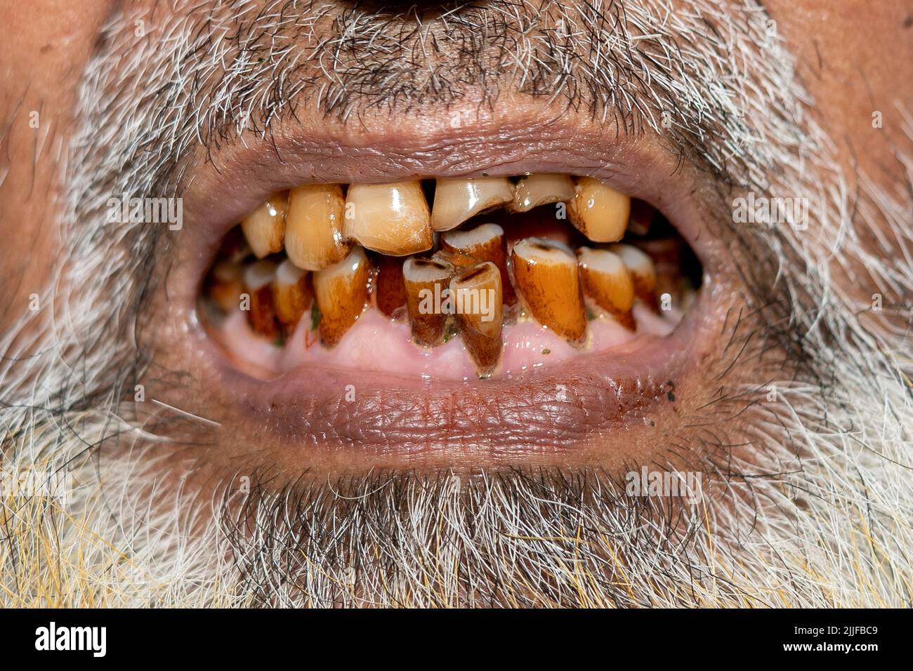 Alte Füllungen an den Zähnen. 24-07-2022 Stockfoto