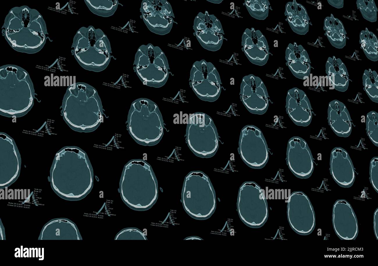 Medizinische Bilddaten aus einer CT- oder MRT-Computertomographie Stockfoto