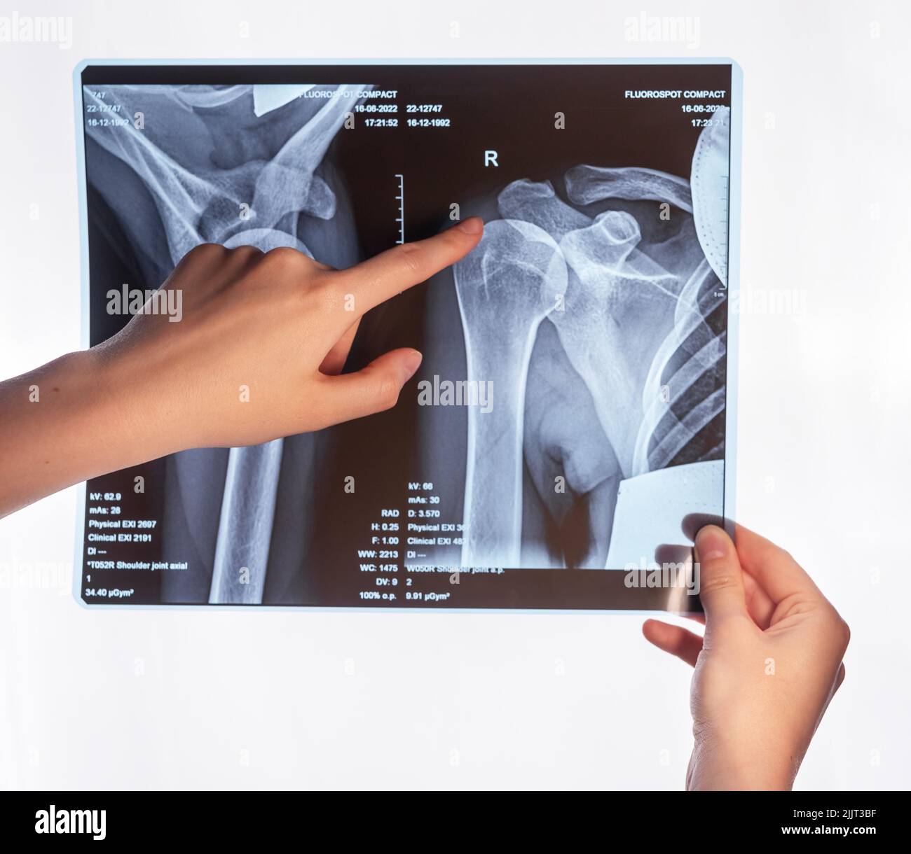 Zeigefinger, der auf ein Trauma am Röntgenbild des Arms zeigt. Akromion, akromiale Endfraktur. Arzt zeigt Schulter, Schlüsselbein überbeanspruchen Verletzungen. Identifizierung und Diagnose von Erkrankungen. Hochwertige Fotos Stockfoto