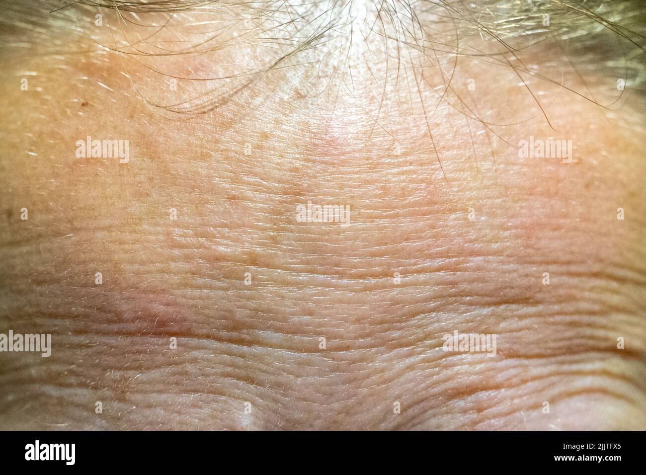 Die Stirn einer Frau mit problematischer Haut Stockfoto
