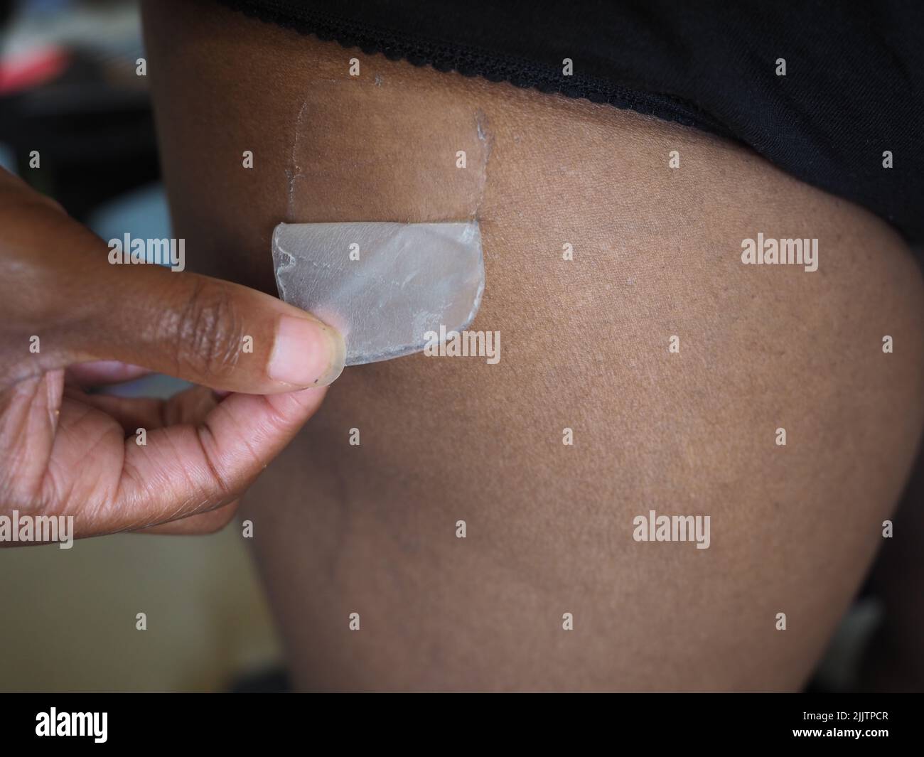 HRT Patch wird von der Haut einer Frau mit Farbe geschält Stockfoto