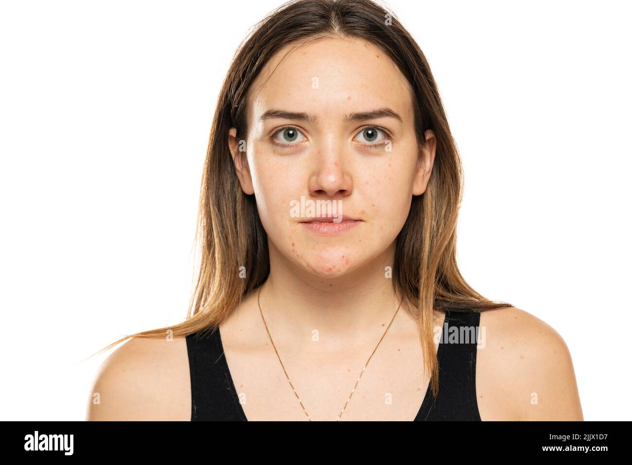 Porträt einer schönen Frau ohne Make-up, und problematische Haut auf weißem Hintergrund Stockfoto