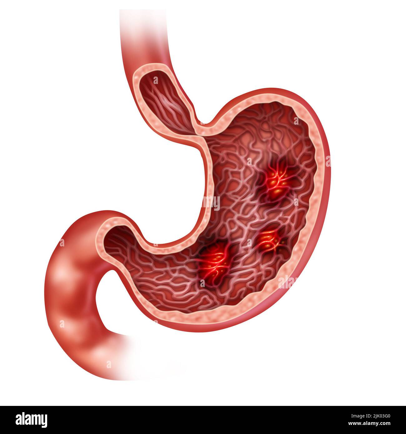 Magengeschwüre und ein schmerzhaftes Geschwürkonzept mit brennenden Verdauungsschmerzen im Verdauungssystem als medizinische Illustration der menschlichen Verdauungsorga Stockfoto