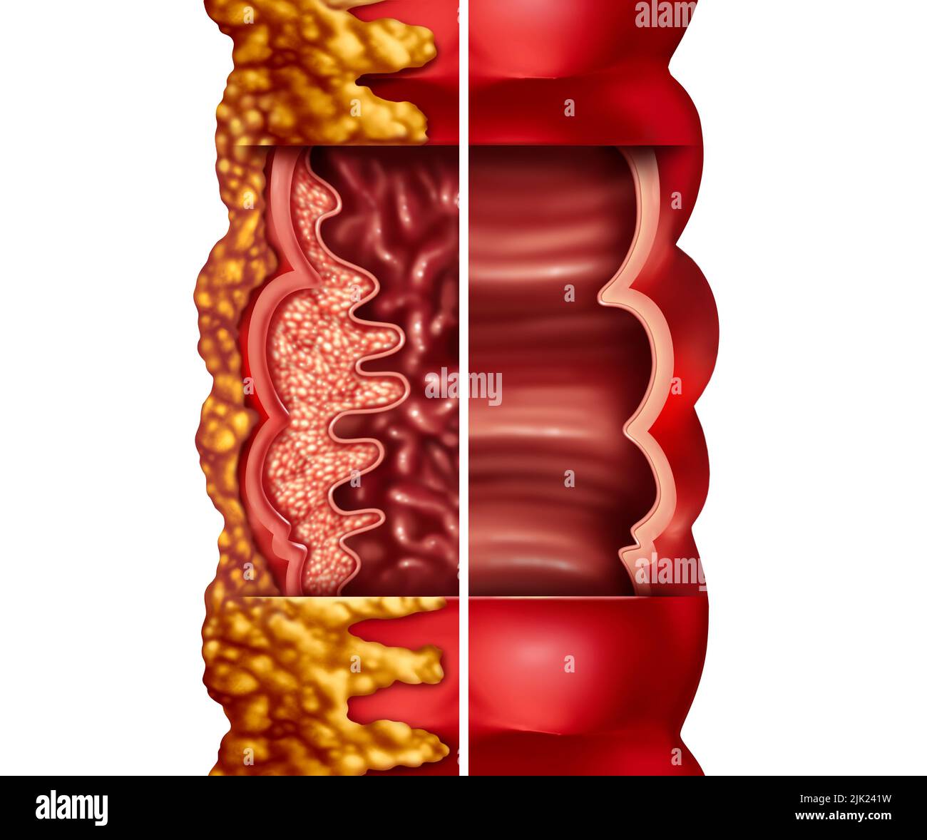 Morbus Crohn und Crohn-Syndrom Krankheit oder Crohns-Krankheit und gesunder Dickdarm als medizinisches Konzept mit Nahaufnahme eines menschlichen Darms Stockfoto