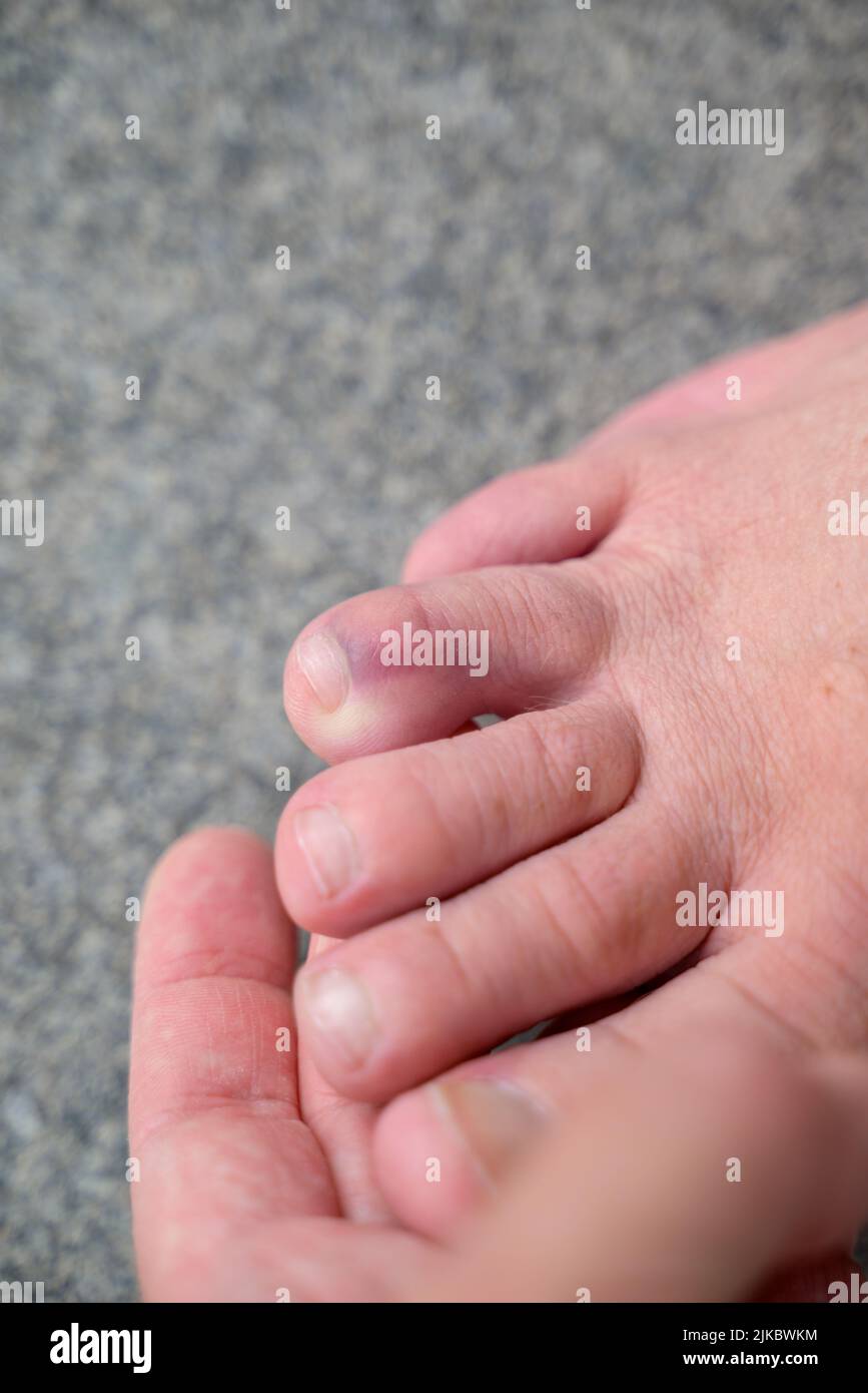 Nahaufnahme der gebrochenen Zehe eines älteren Mannes, der Prellungen oder Blutergüsse mit Copyspace zeigt Stockfoto