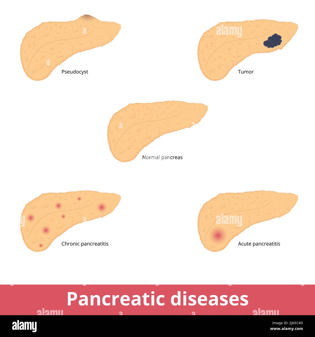 Erkrankungen der Bauchspeicheldrüse. Visualisierung von häufigen Pankreaserkrankungen, einschließlich Pseudozyste, Tumor, chronischer und akuter Pankreatitis. Stock Vektor