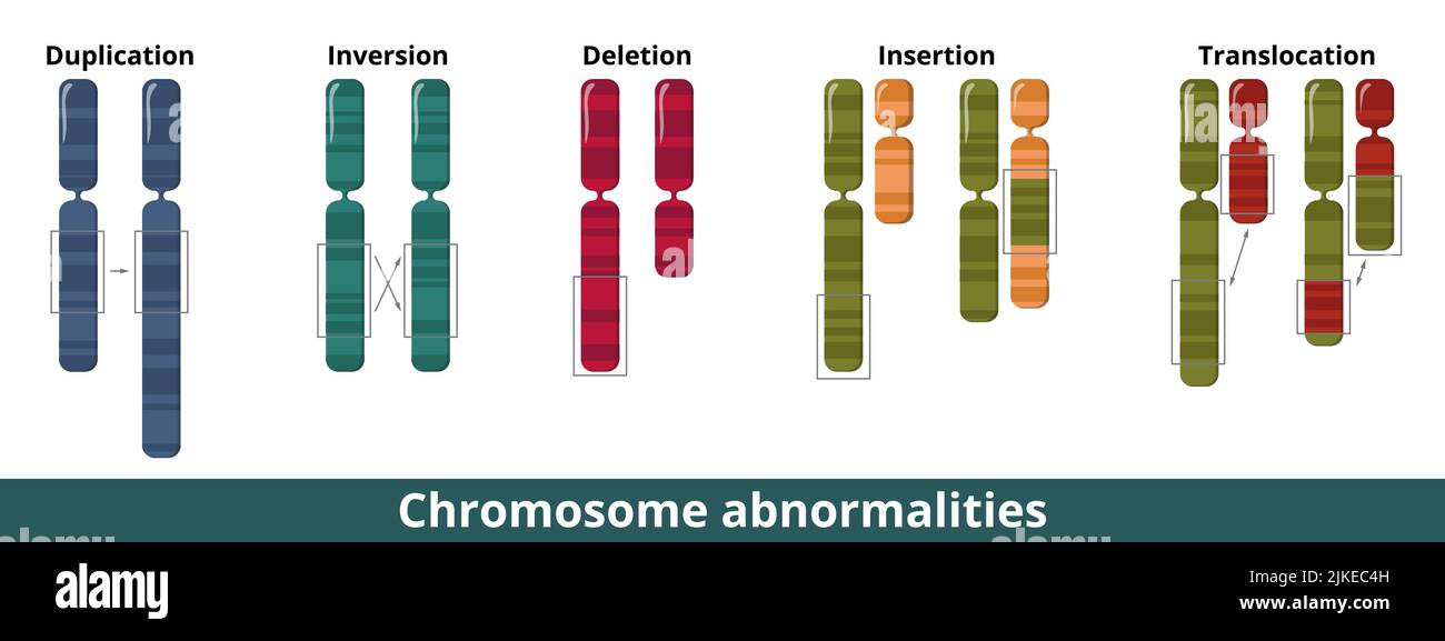 Visualisierung von häufigen chromosomalen Mutationen oder Störungen. Numerische oder strukturelle Anomalien, bei denen eine fehlende, extra chromosomale DNA vorhanden ist. Stock Vektor