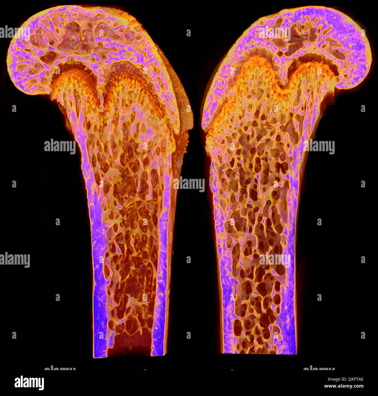 Dieses Bild zeigt mikrocomputergestützte Tomograophie (Mikro-CT) Rekonstruktionen von Femuren des 9 Wochen alten Mannes von Dlx3+/+ (linke Hälfte) und Dlx3Prx1-CKO (rechte Hälfte) Mäusen. Die Bilder sind sagittale Abschnitte mit mittleren Knochen und Farbverlauf, der der Mineraldichte des Knochens entspricht. Stockfoto