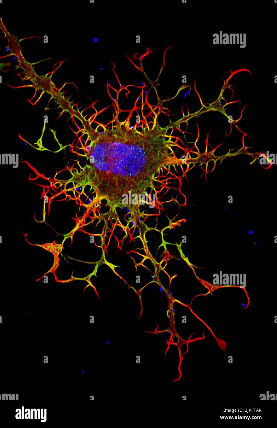 Es ist eine Fibroblast, eine Bindegewebszelle, die eine wichtige Rolle bei der Wundheilung spielt. Normale Fibroblasten haben glatte Kanten. Andererseits fehlt dieser borstigen Zelle ein Protein, das für den ordnungsgemäßen Aufbau der Zelle und des Skeletts notwendig ist. Stockfoto