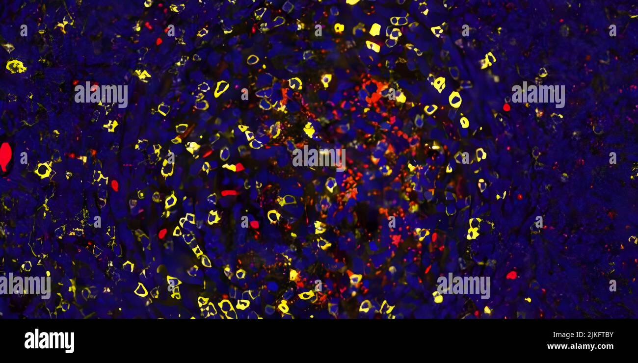 In diesem Bild des Lymphgewebes, das einer Person mit unkontrollierter HIV-Infektion aus dem Hals entnommen wurde, können Sie Bereiche sehen, in denen sich HIV (in rot) inmitten eines Meeres von Immunzellen (blaue Punkte) repliziert. Bereiche mit der größten HIV-Replikation sind mit einer hohen Dichte eines Subtyps von menschlichen CD4-T-Zellen (gelbe Kreise) assoziiert, die nachweislich besonders anfällig für HIV-Infektionen sind. Stockfoto