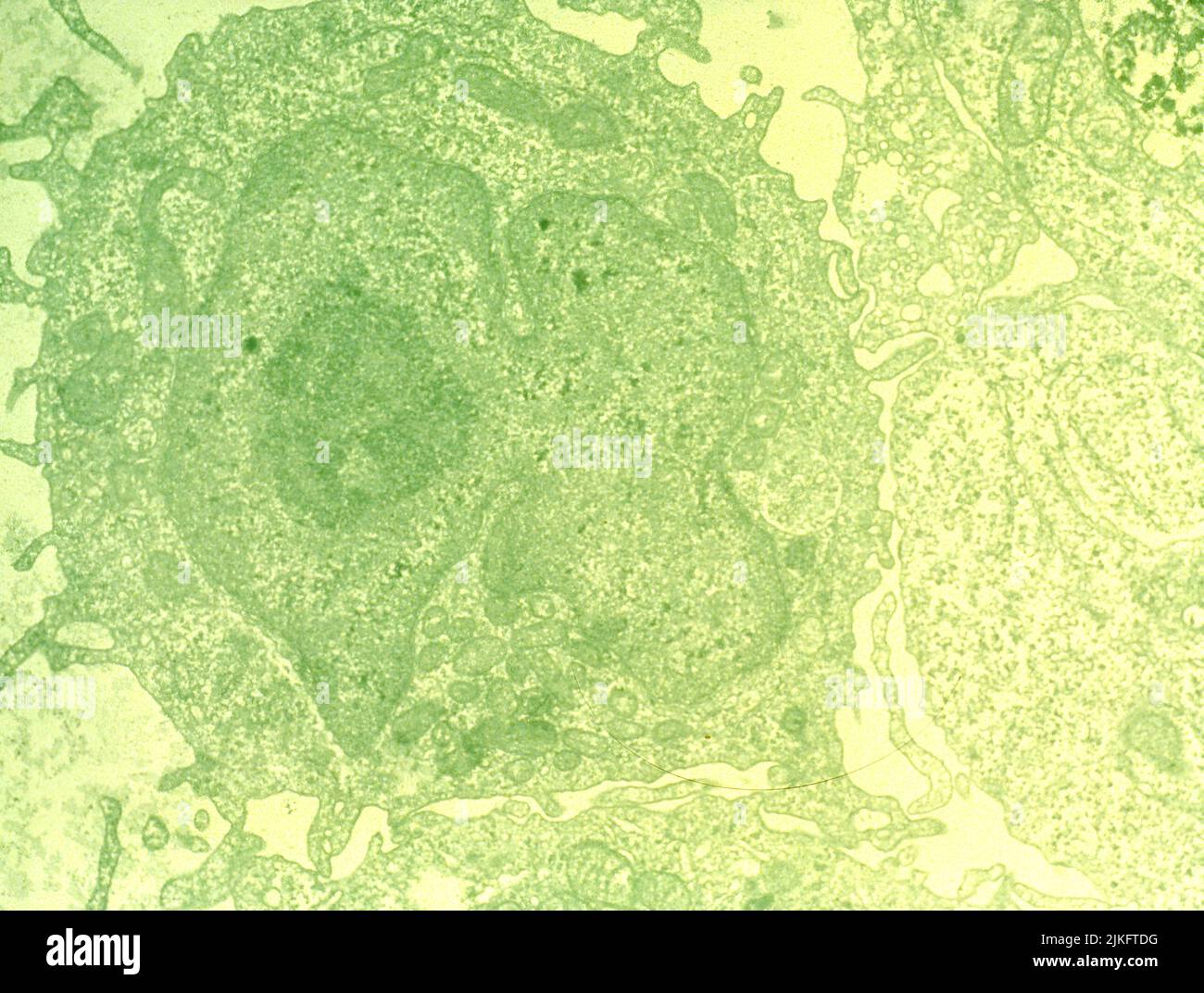 Eine histologische Folie mit Leukämie der haarigen Zelle. Stockfoto