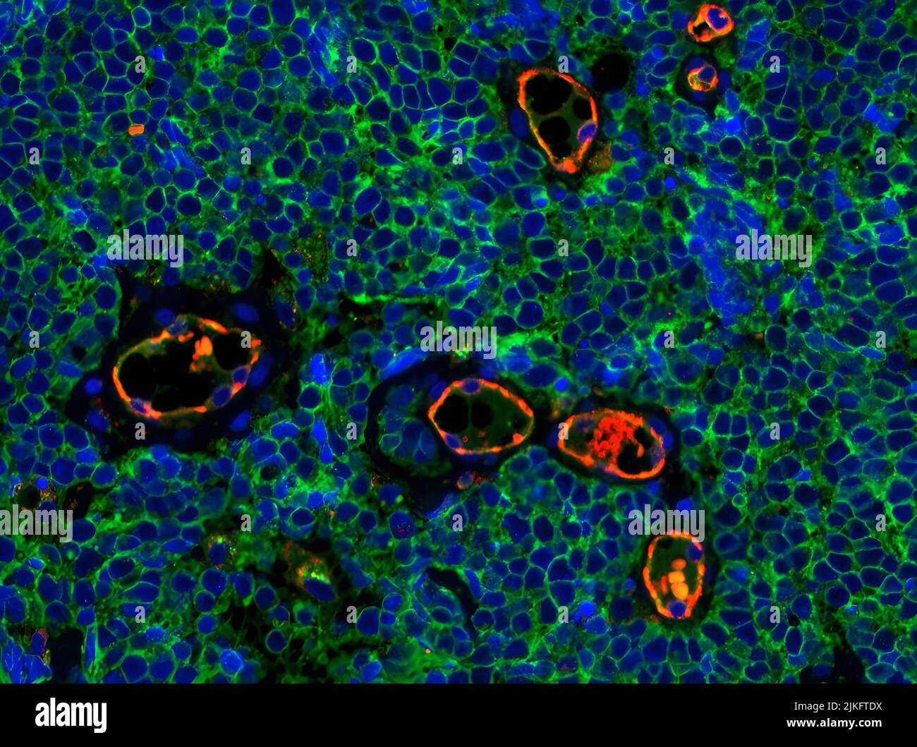 Immunfluoreszierende Färbung des Merkelzellkarzinom-Tumorgewebes, die die Expression von CD200 (grün) auf der Oberfläche von Tumorzellen veranschaulicht. CD200 spielt eine Rolle bei der Immunsuppression. Der Endothelmarker CD31 (rot) markiert die Blutgefäße. Das Merkel-Zellkarzinom ist ein seltener und aggressiver Hautkrebs. Stockfoto