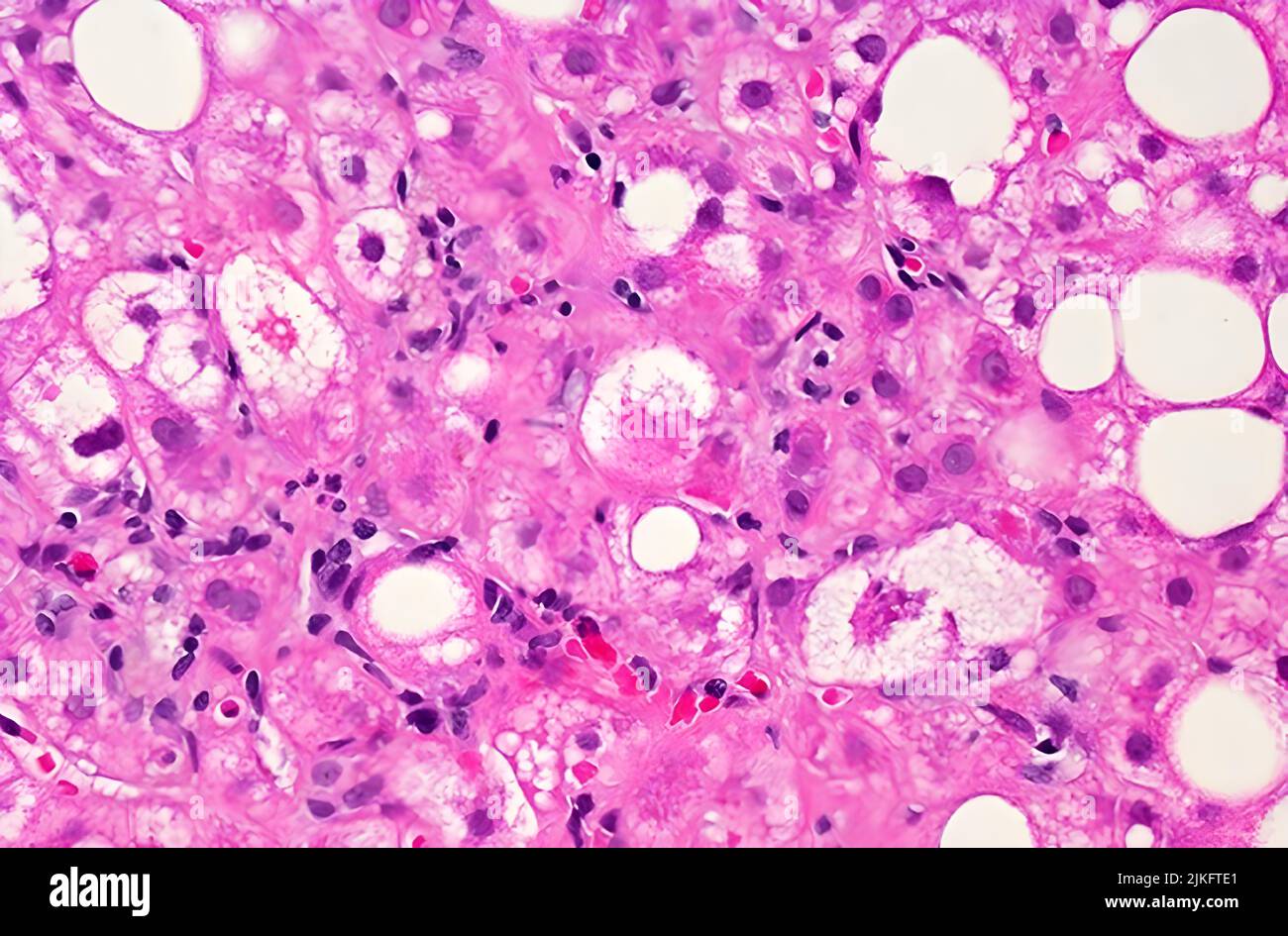 Ein mikroskopisches Bild von Lebergewebe, das von einer nicht-alkoholischen Fettleber-Erkrankung (NAFLD) betroffen ist. Die großen und kleinen weißen Flecken sind überschüssige Fetttröpfchen, die Leberzellen (Hepatozyten) entwickeln. Stockfoto