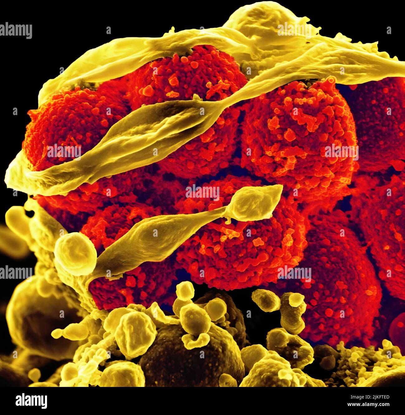 Rasterelektronenmikroskopie von Methicillin-resistenten Staphylococcus aureus-Bakterien (gelbe, runde Objekte), die eine menschliche weiße Blutkörperchen töten und aus ihr entweichen. Stockfoto