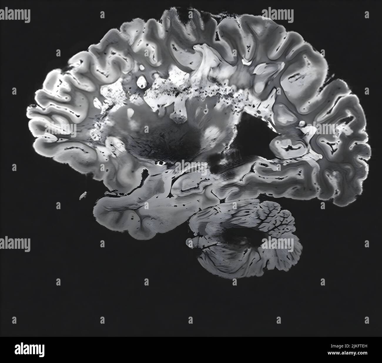 Dies ist ein pseudo-farbiger Bildausschnitt eines hochauflösenden Gradientenecho-MRT einer festen Gehirnhemisphäre einer Person mit multipler Sklerose. Stockfoto