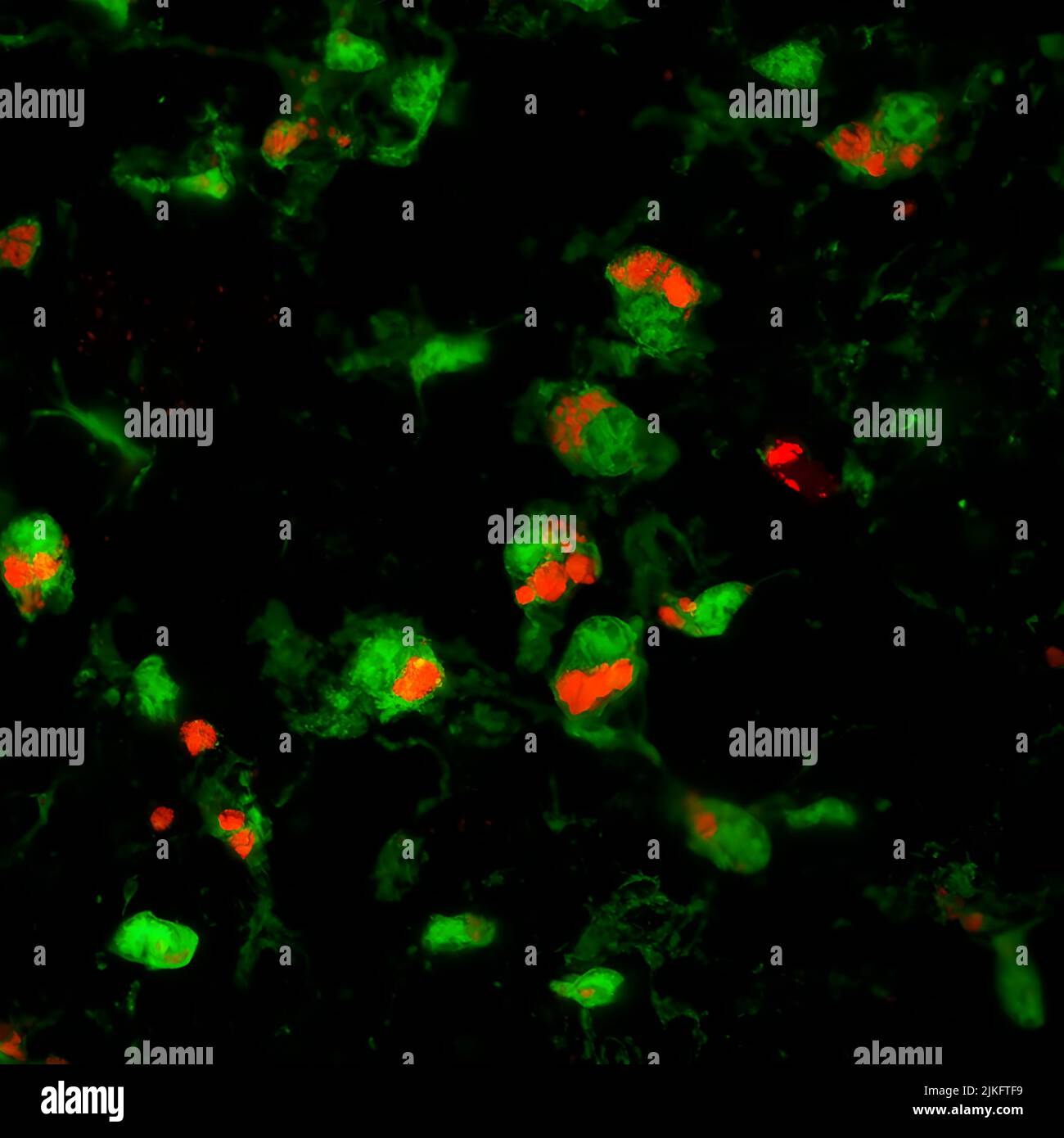 Mikroglia, eine Art Nervensystemzelle, die zuvor unter dem Verdacht steht, eine Schädigung der Netzhaut zu verursachen, hat sich als vorteilhaft erwiesen, um das Fortschreiten der Prionerkrankung im Gehirn und jetzt in der Netzhaut zu verlangsamen. In diesem Bild verschlingen und entfernen Mikrogliazellen (grün) priongeschädigte Photorezeptoren (rot), die die Netzhautdegeneration zu verlangsamen scheinen. Stockfoto