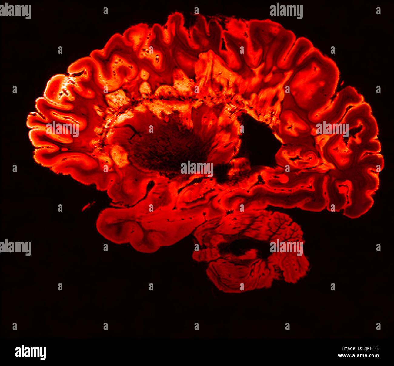 Dies ist ein pseudo-farbiger Bildausschnitt eines hochauflösenden Gradientenecho-MRT einer festen Gehirnhemisphäre einer Person mit multipler Sklerose. Stockfoto