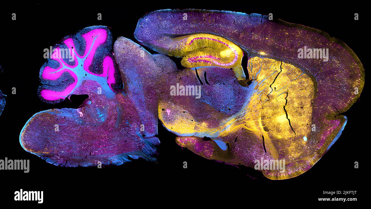 Gehirn einer Maus mit Niemann-Pick neurodegenerativer Krankheit Typ C1. Stockfoto