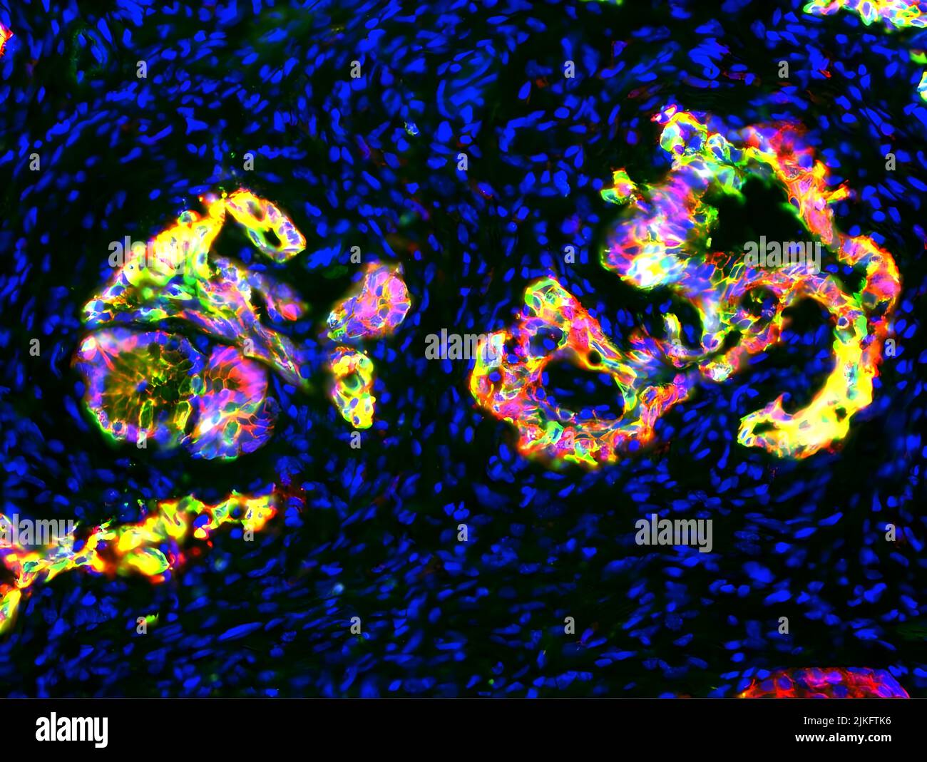 In diesem auffälligen Bild, das in der Research as Art-Ausstellung der University of Utah von 2016 gezeigt wurde, zeigt Rot ein Keratin-Protein, das im Zytoskelett präkanzerer Zellen gefunden wurde, Grün, ein Zelladhäsionsprotein namens E-Cadherin und das Eigelb, die Bereiche, in denen die beiden Proteine vorhanden sind. Schließlich markiert Blau die Zellkerne von reichlich vorhandenen Immunzellen und Fibroblasten, die gewachsen sind und das Organ infiltriert haben, wie ein Tumor gebildet hat. Gemeinsam zeichnen sie ein faszinierendes neues Porträt des Pankreas-duktalen Adenokarzinoms (PDAC), der häufigsten Form von Bauchspeicheldrüsenkrebs. Stockfoto