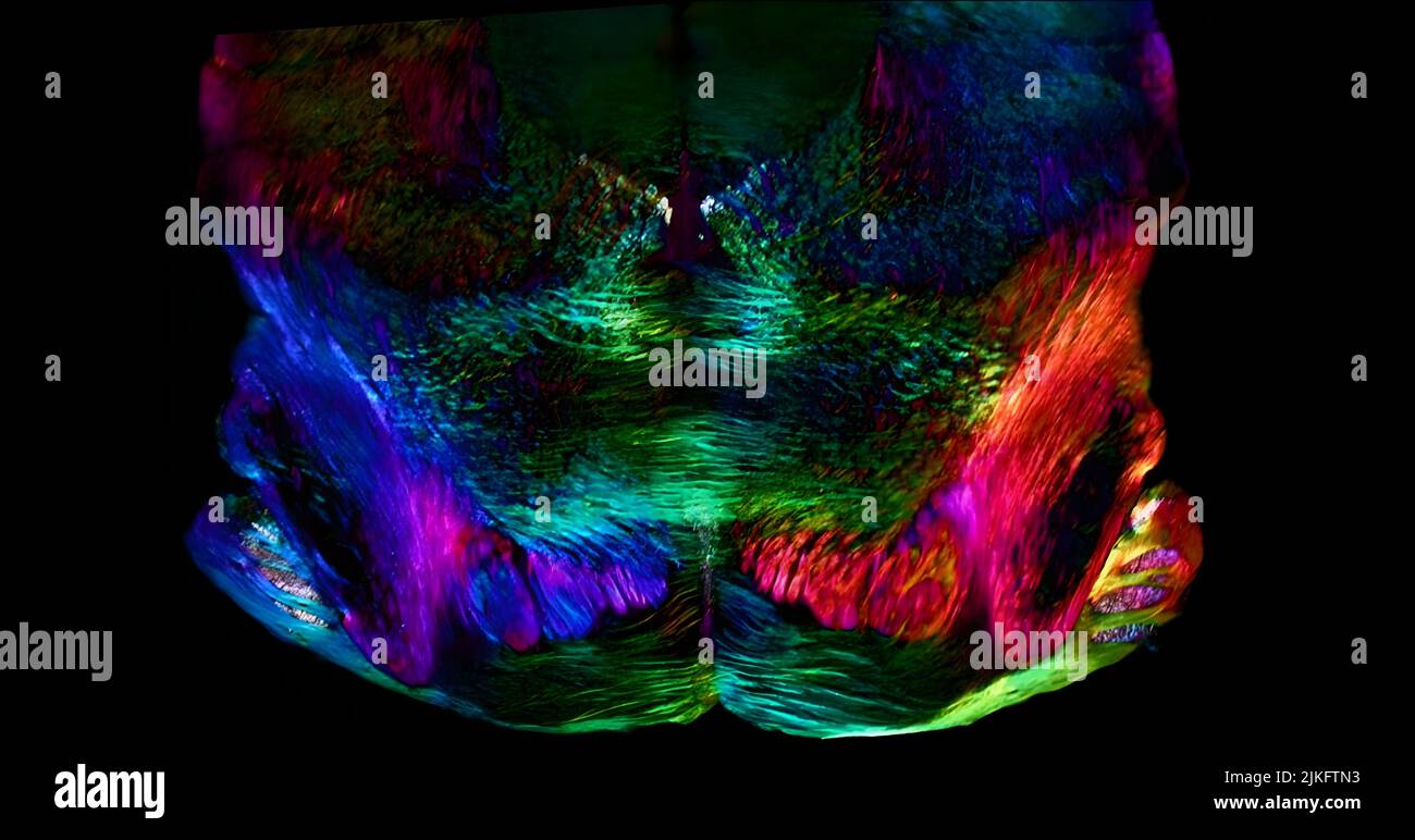In diesem Bild haben die Forscher mit einem neu entwickelten polarisierten Lichtmikroskop die räumliche Orientierung von Neuronen in einem dünnen Abschnitt des Mäuse-Mittelhirns dargestellt. Die sich horizontal ausdehnenden Neuronen werden grün dargestellt, während die in einem 45-Grad-Winkel orientierten Neuronen rosa rot und die in 225-Grad-Winkel violettblau sind. Diese Farben beinhalten keine Färbung oder Kennzeichnung der Zellen mit fluoreszierenden Markern: Die Farben werden ausschließlich von Licht emittiert, das mit der physischen Ausrichtung jedes Neurons interagiert. Stockfoto