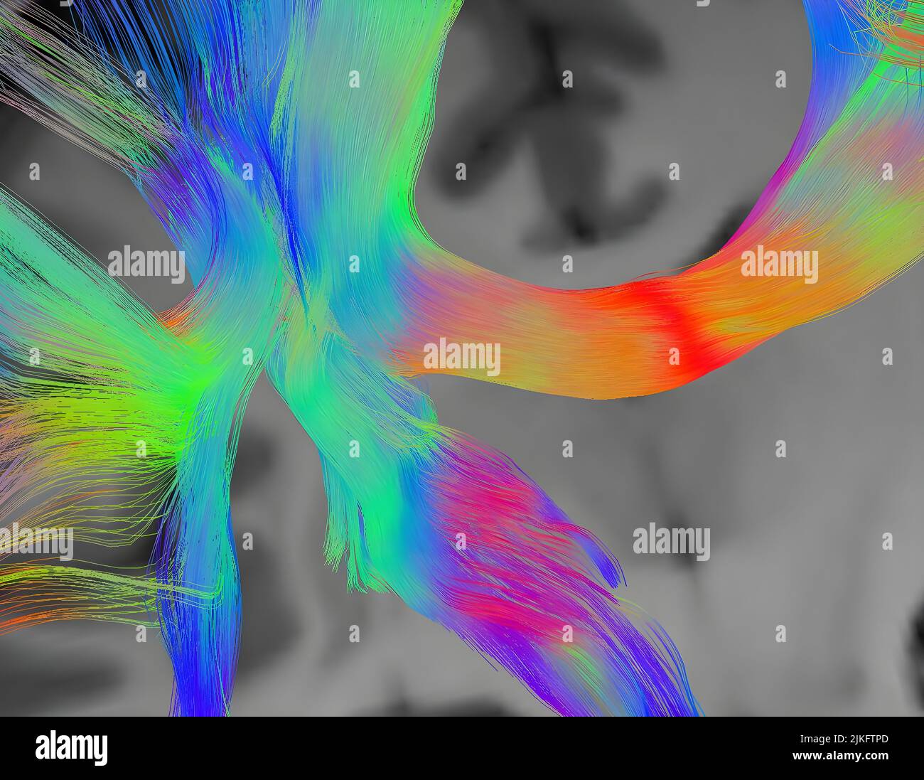 Dieser Spread Spectrum Imaging Scan, der 257 Richtungen über einen Bereich unterschiedlicher Gradientenstärken aufzeichnet, zeigt die Traktographie an einer dreifachen Kreuzung in der weißen Substanz des Parietallappen. Stockfoto