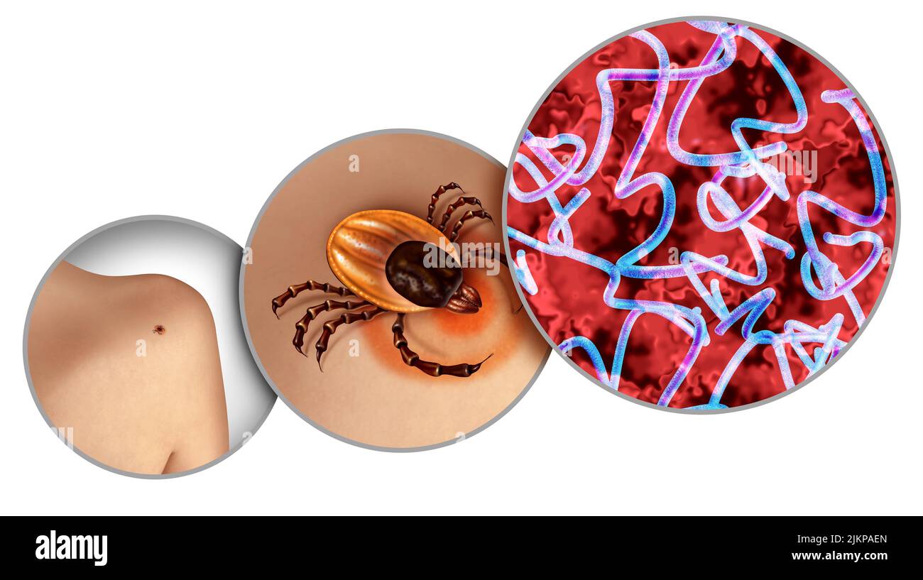 Lyme-Borreliose und Hirsch Zecke kriechen auf der Haut als bakterielle Infektion Gesundheitsgefahr als der Biss eines Parasiten verursacht eine Krankheit mit Bakterien. Stockfoto