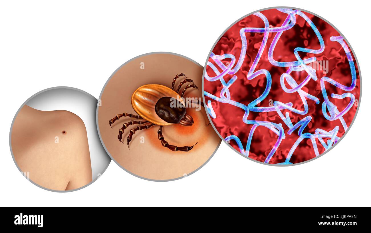 Lyme-Borreliose und Hirsch Zecke kriechen auf der Haut als bakterielle Infektion Gesundheitsgefahr als der Biss eines Parasiten verursacht eine Krankheit mit Bakterien. Stockfoto
