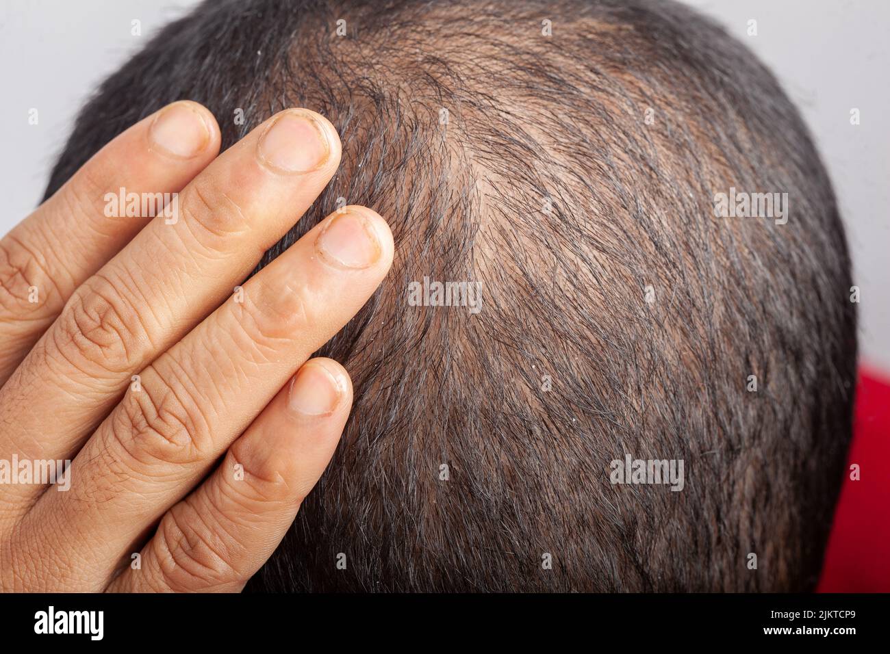 Kahlheit, Haarausfall, Schuppen am Kopf, sichtbare Kopfhaut. Mann, der sein dünnes Haar oder seinen Alopezie-Kopf berührt. Stockfoto