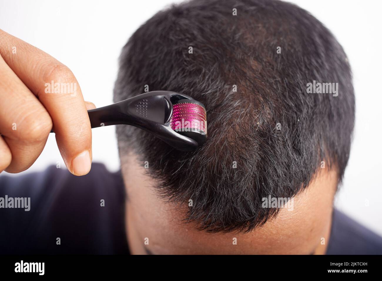 Mikroneedling, junger Mann, der Derma-Walze am Kopf verwendet, um das neue Haarwachstum zu stimulieren und Haarausfall oder androgenetische Alopezie zu reduzieren Stockfoto