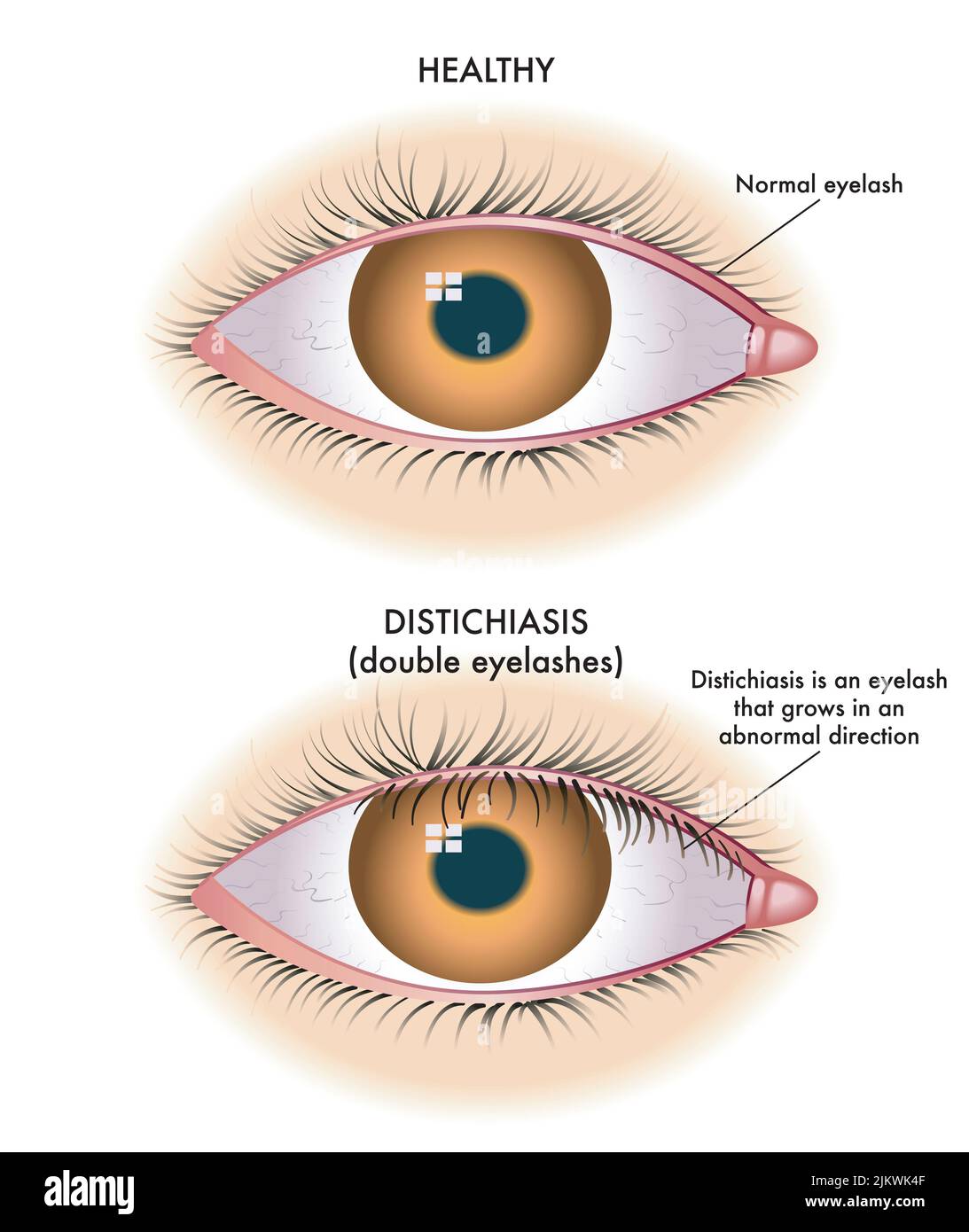 Die medizinische Illustration zeigt den Vergleich zwischen einem normalen Auge und einem von der Destichiasis betroffenen Auge. Stockfoto