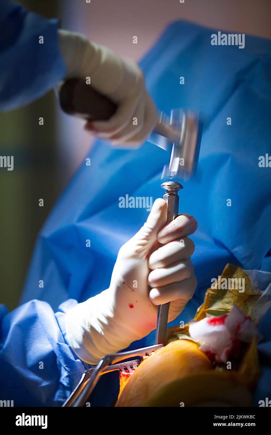 Orthopädische Chirurgie Operationssaal für Akromioplastik und Tenodese des Bizeps. Stockfoto