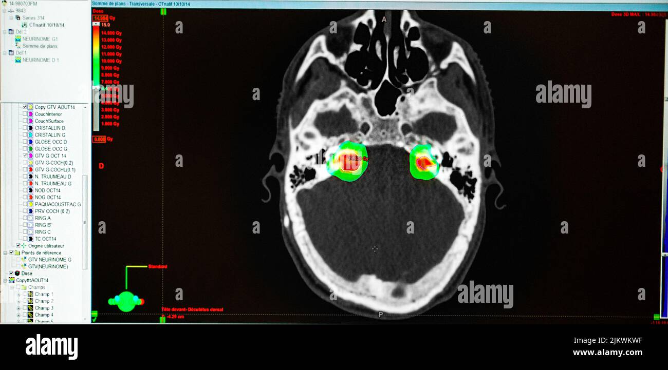 Behandlung eines Neuromas, das durch Radiochirurgie behandelt wird. Stockfoto