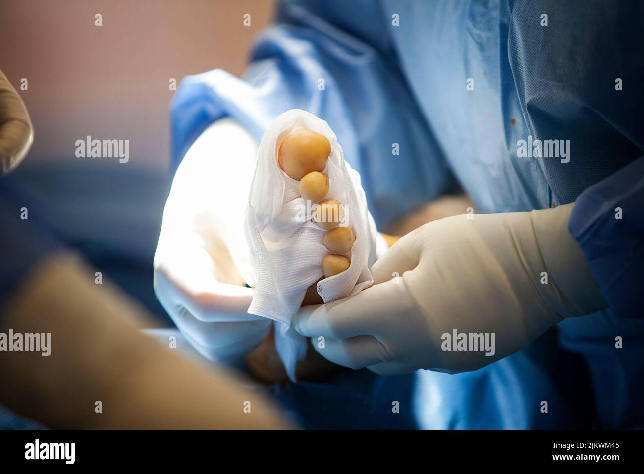 Orthopädische Chirurgie, Verband nach Arthrodese der großen Zehe. Stockfoto