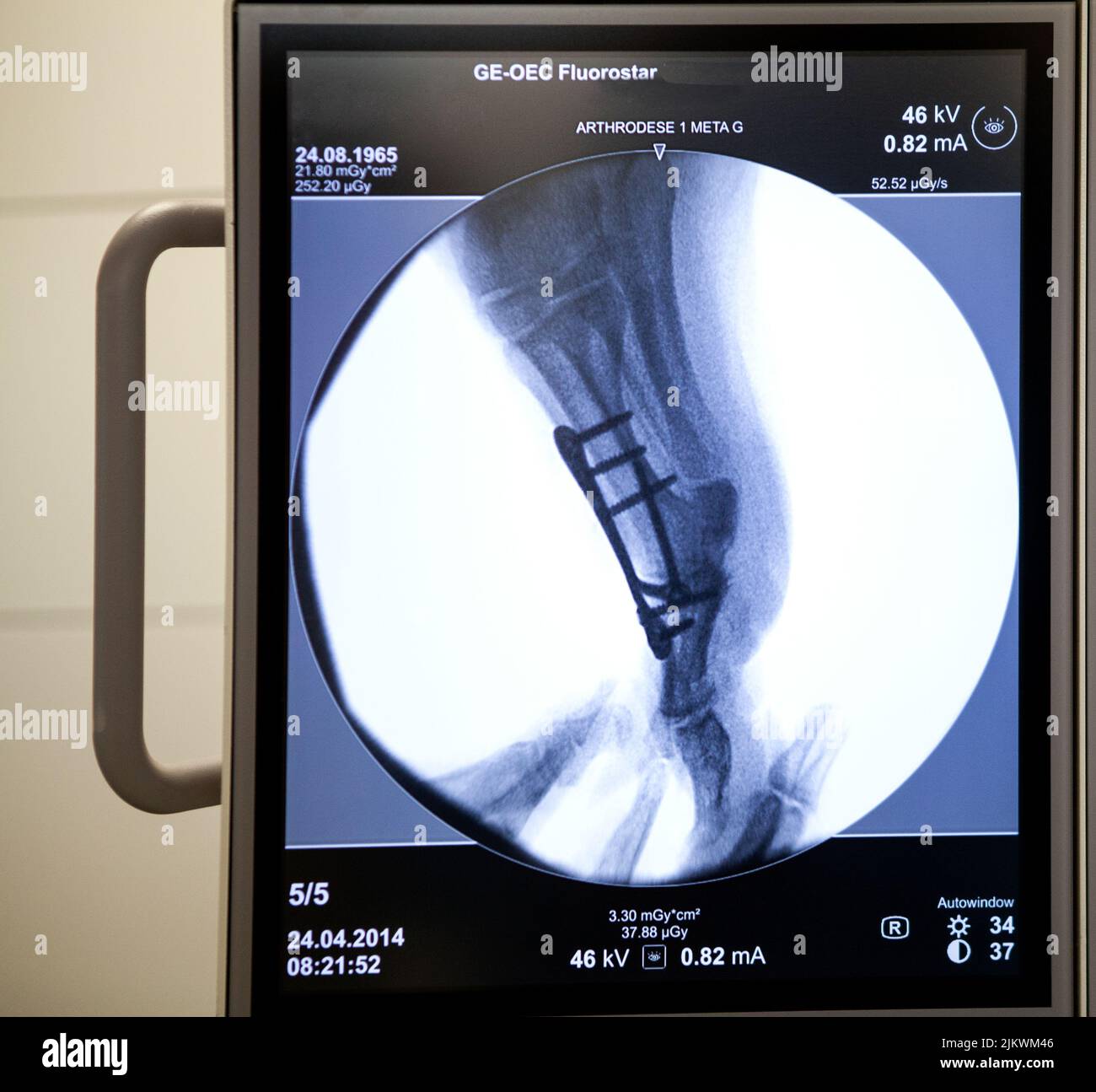 Bericht an die orthopädische Chirurgie der Krankenhäuser Léman in Thonon. Operationssaal. Röntgenaufnahme des Fußes eines Patienten, der gerade eine Arthrodese des großen Zeh hatte. Stockfoto