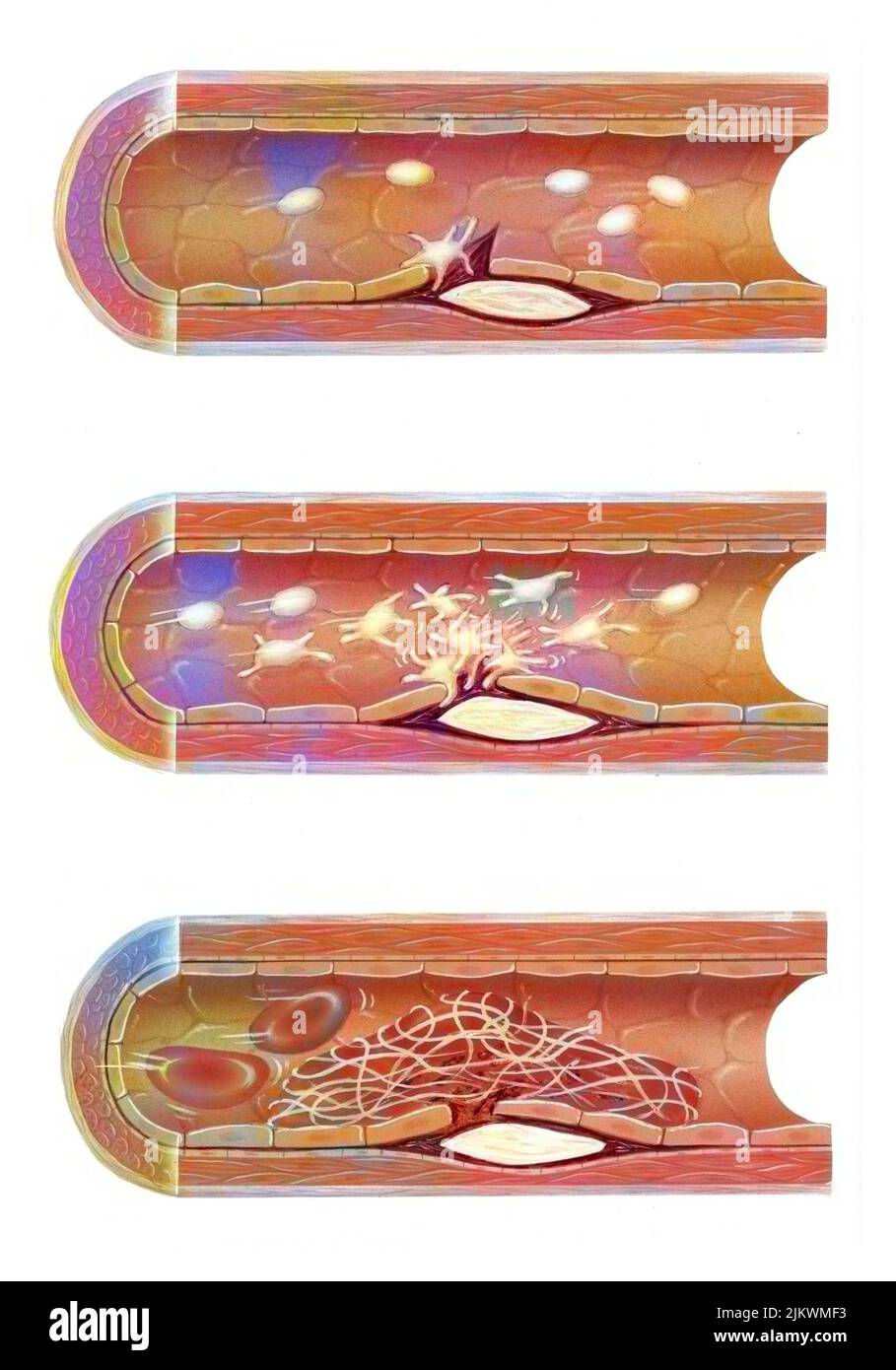 Atherom: Läsion der inneren Oberfläche der Arterien durch eine Ablagerung von Cholesterin. Stockfoto