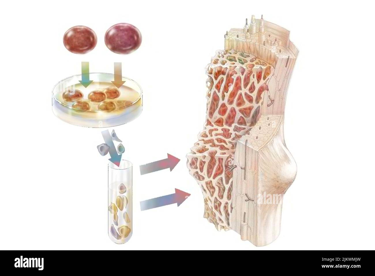 Transplantation von hämatopoetischen Stammzellen verabreicht, um das Knochenmark zu besiedeln. Stockfoto