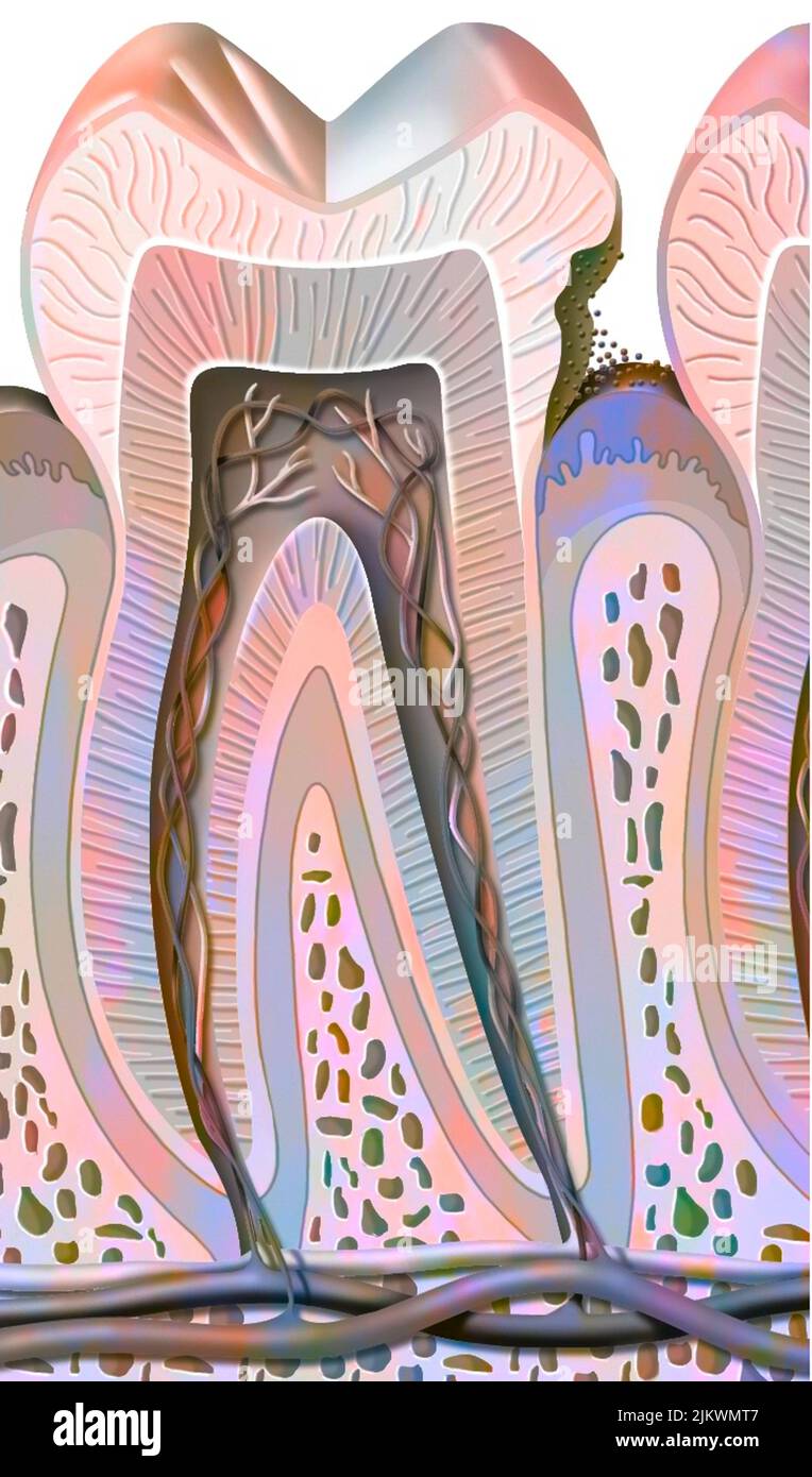 Zahnkaries im ersten Stadium (Zahnschmelzschäden). Stockfoto