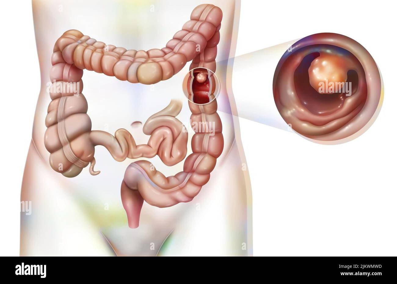 Verdauungssystem: Der Dickdarm mit einem kolonischen Polyp. Stockfoto