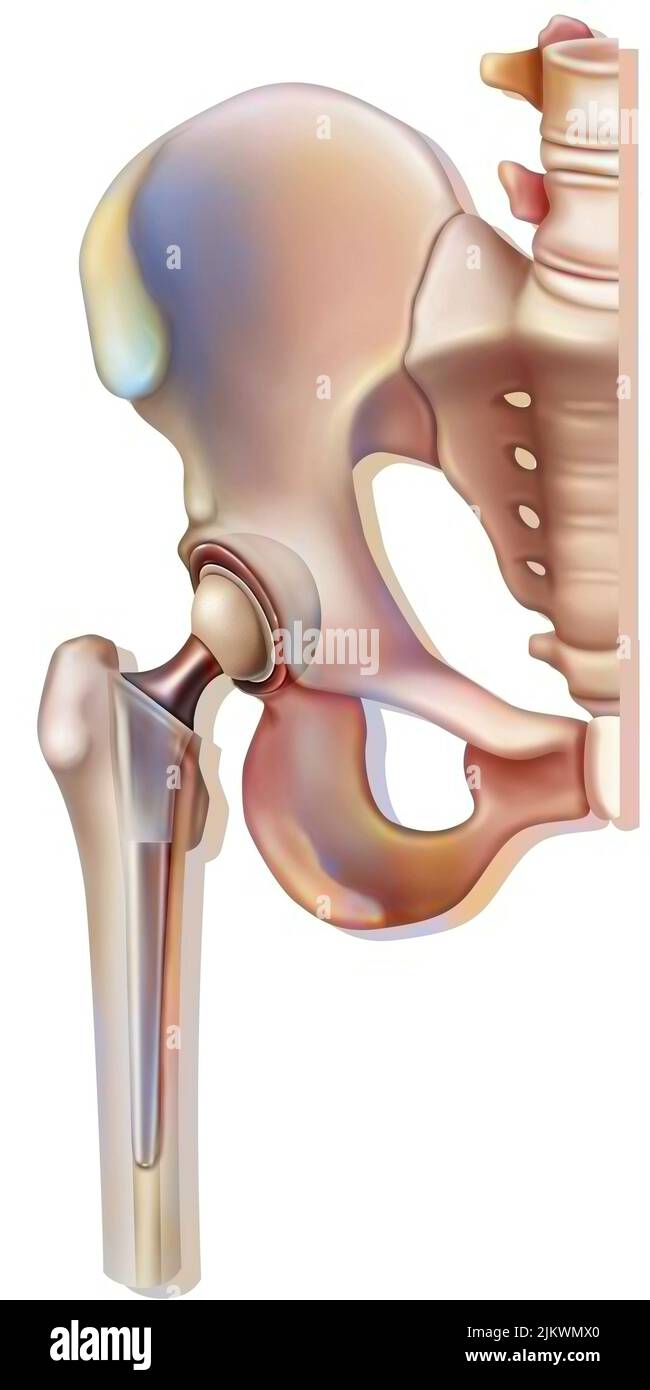 Knochensystem: Hüftprothese. Stockfoto