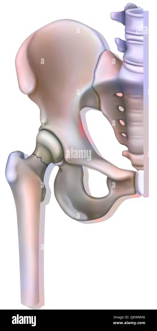 Knochensystem: Fraktur des Halses des Oberschenkels, verbunden mit Osteoporose. Stockfoto