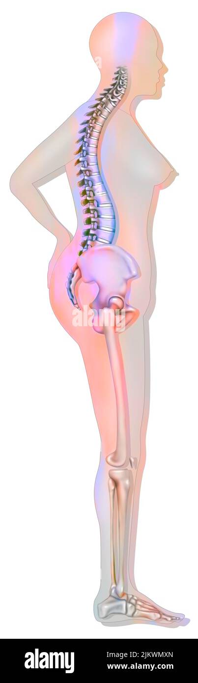 Knochensystem: Silhouette einer 60-jährigen Frau mit mäßiger Osteoporose. Stockfoto