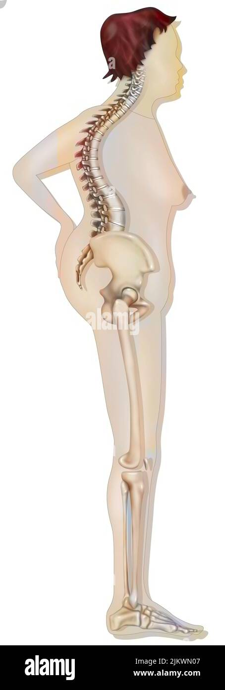 Knochensystem: Silhouette einer 70-jährigen Frau mit schwerer Osteoporose. Stockfoto