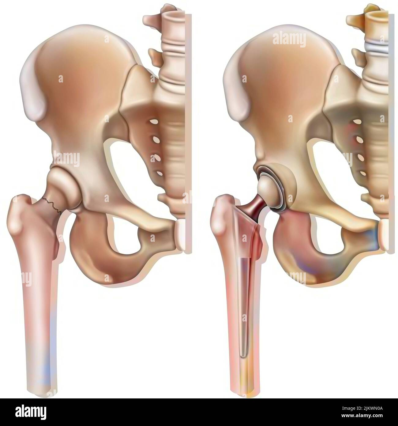 Oberschenkelhalsfraktur (Osteoporose) und Hüftprothese. Stockfoto