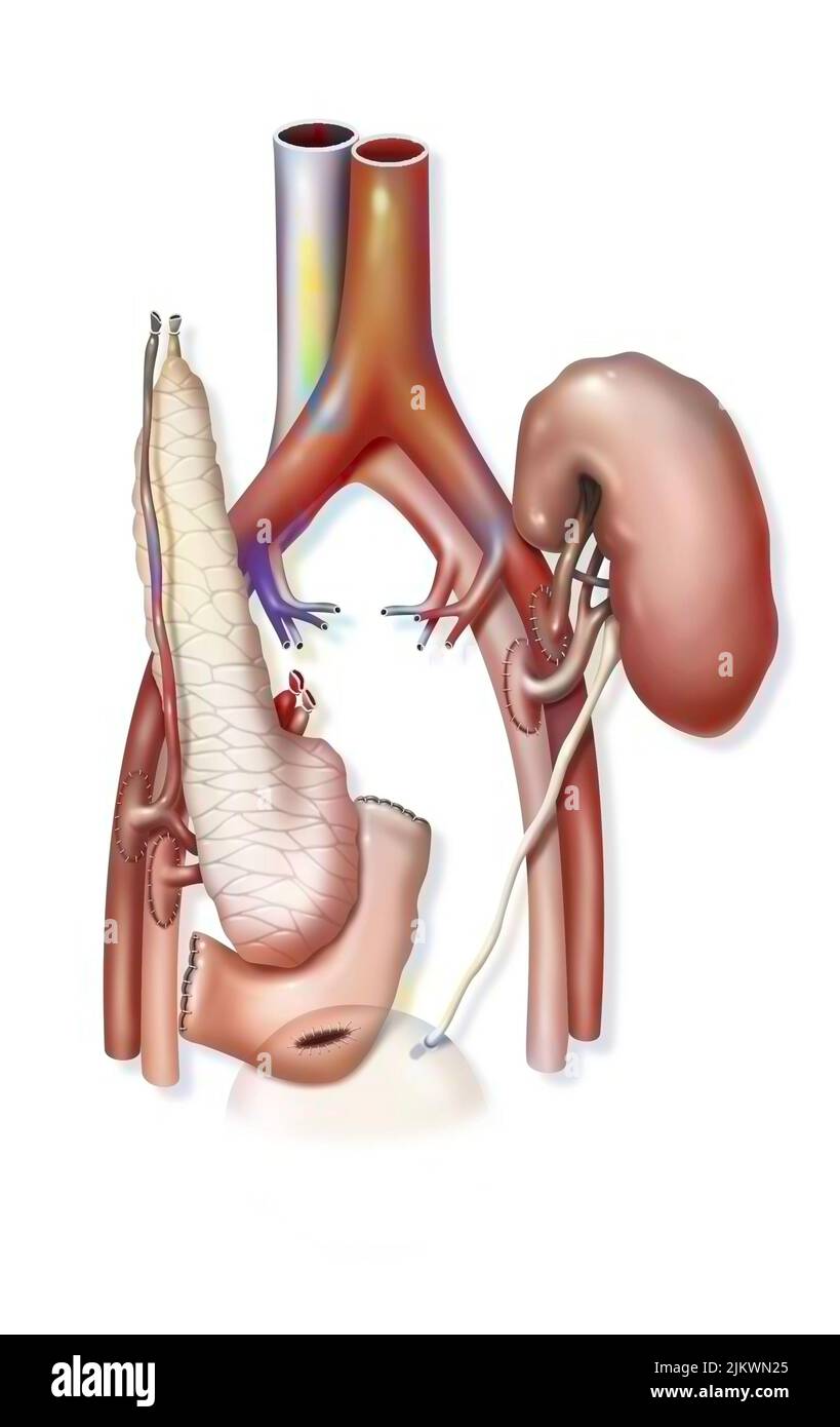 Kombinierte Pankreas- und Nierentransplantation: Implantation von Transplantaten. Stockfoto