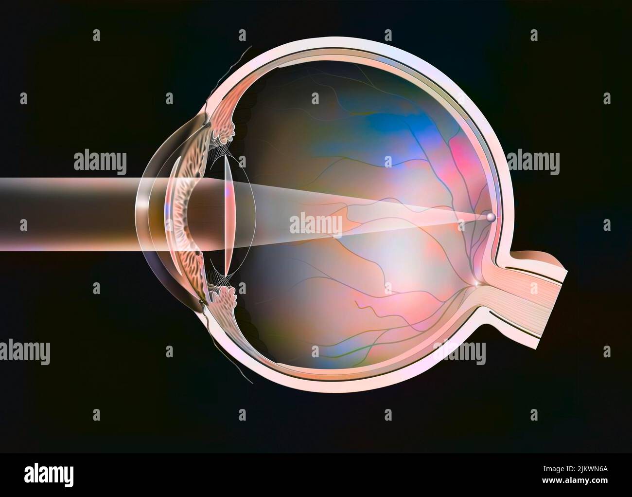 Auge (Katarakt): Intraokulare Implantate in der vorderen und hinteren Kammer. Stockfoto